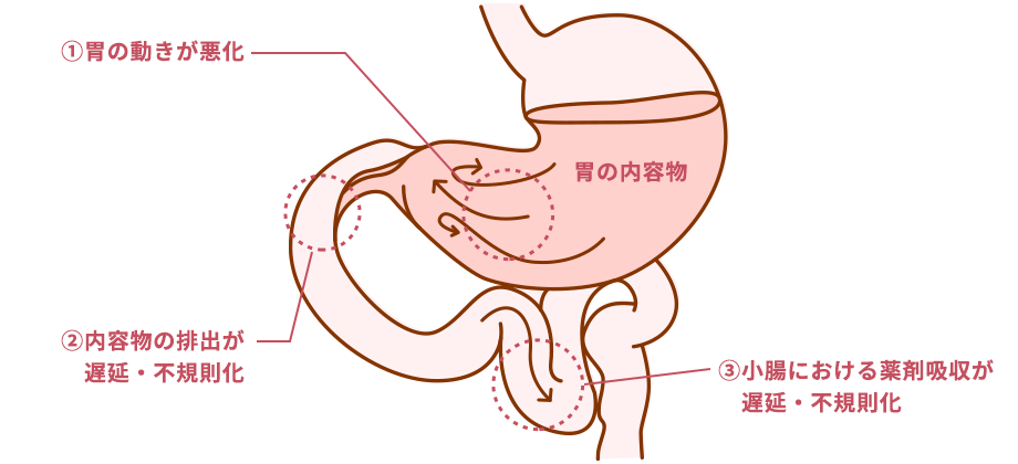 病気の進行に伴う胃の動きのイメージ画像